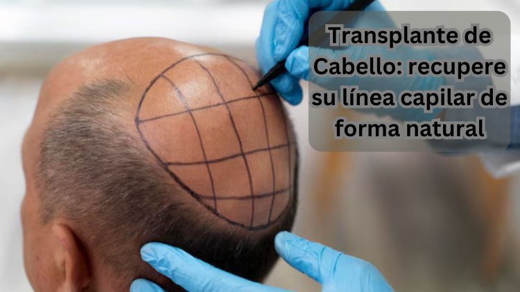 Transplante de Cabello: recupere su línea capilar de forma natural