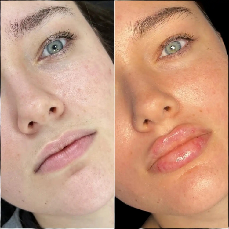 Cost of Fillers in Dubai: What You Need to Know