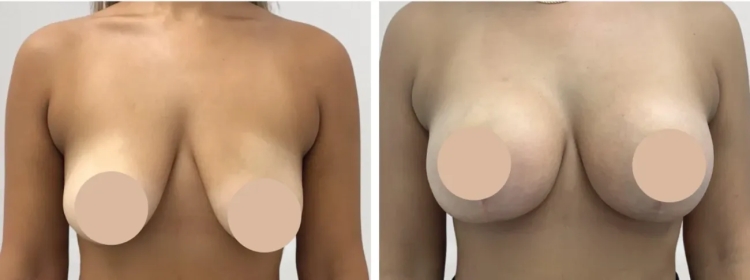 The Journey to a Better You: Breast Lift with the Best Doctors in Dubai