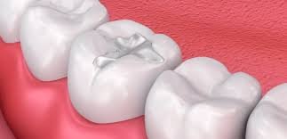 How Do Composite Fillings Compare to Other Types of Fillings?