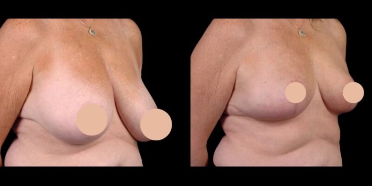 Breast Reduction in Dubai: Why Top Surgeons Recommend This Procedure