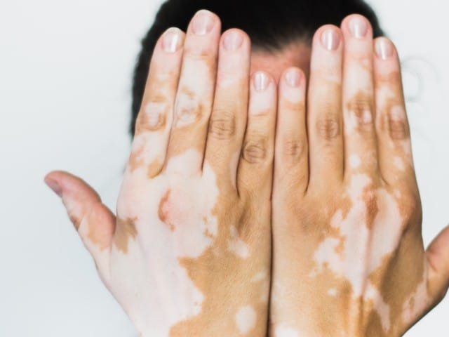 The Science Behind Vitiligo: Myths vs. Facts